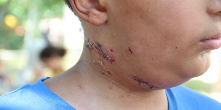 Köpek saldırısına uğrayan 10 yaşındaki çocuk ölümden döndü